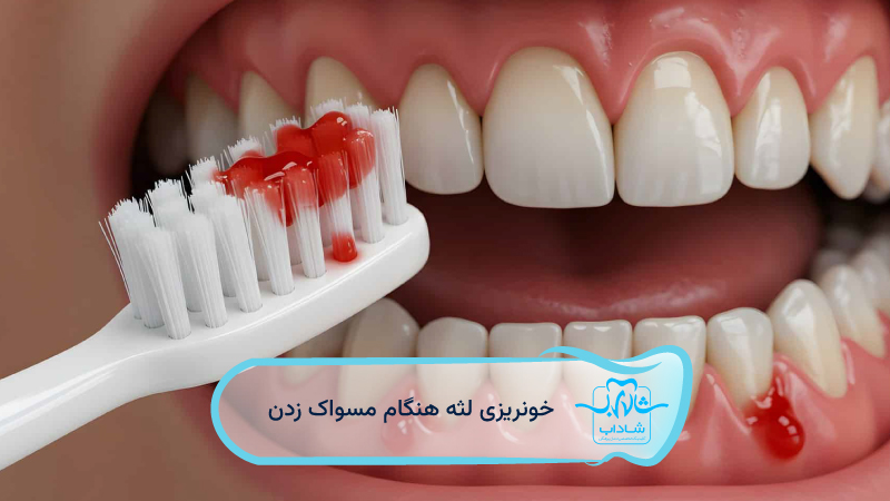 bleeding gums when brushing teeth