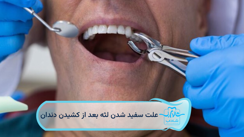 causes whitening gums after tooth extraction