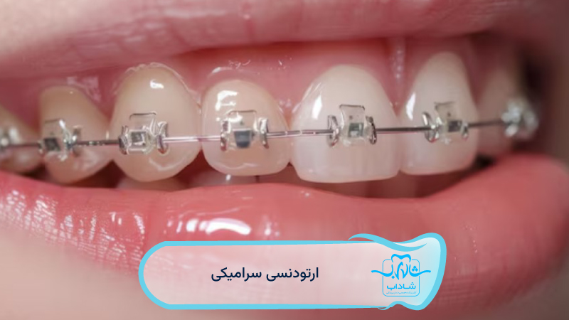 ceramic orthodontics