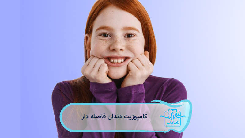 composite dental fillings