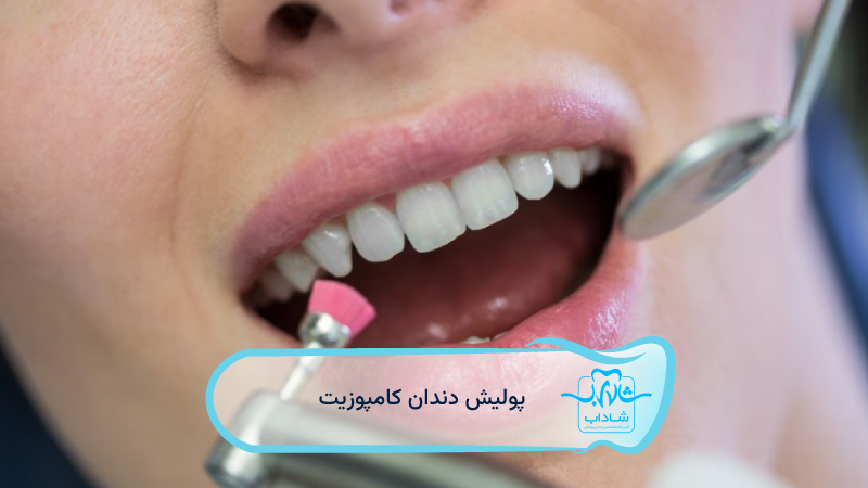 composite tooth polishing