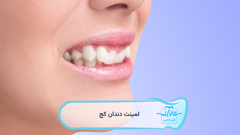 crooked tooth laminate