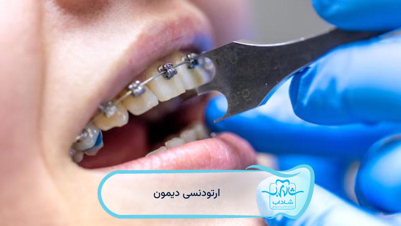 damon orthodontics