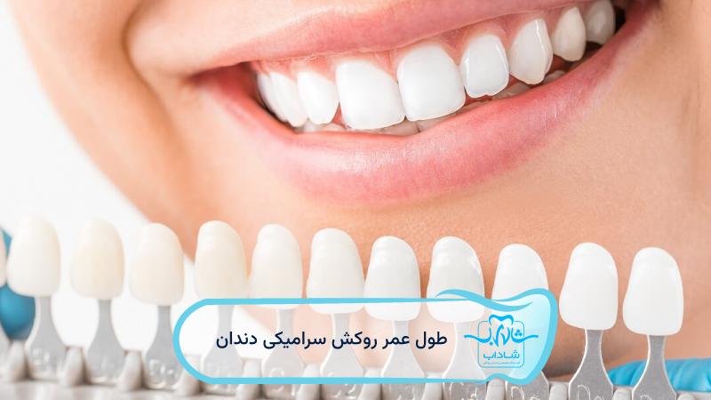 dental-ceramic-crown-lifespan.webp