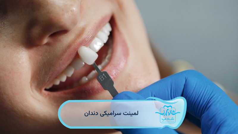 dental ceramic laminate
