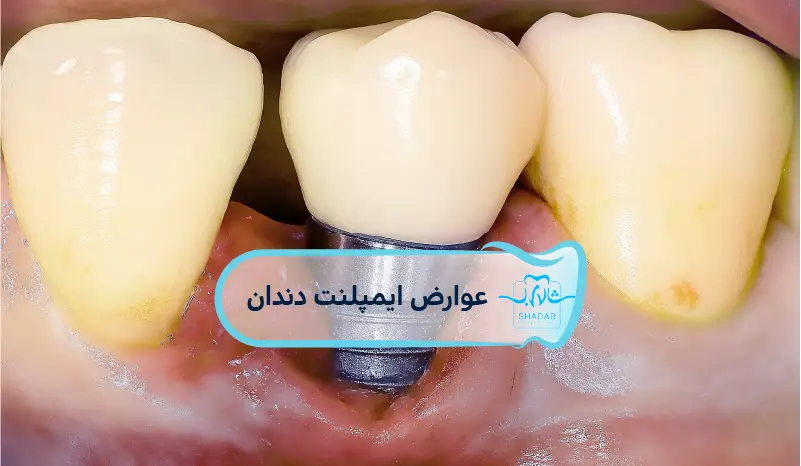 dental implant complications