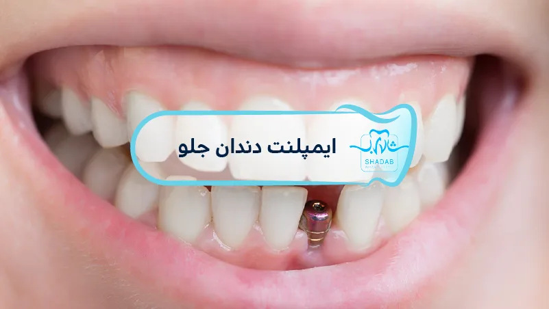 dental implant fron tooth