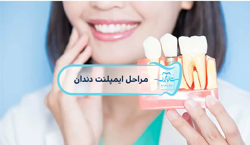 dental implant steps