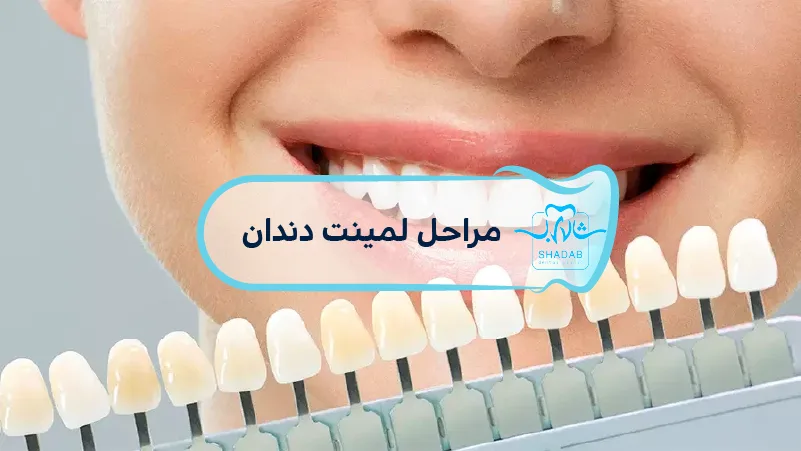 dental laminate steps