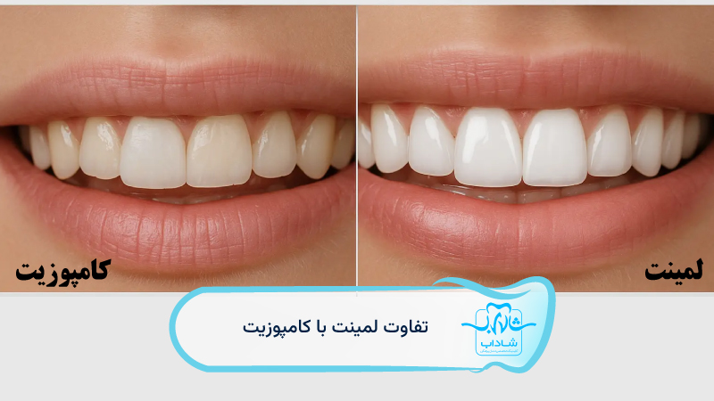 difference between dental laminate composite