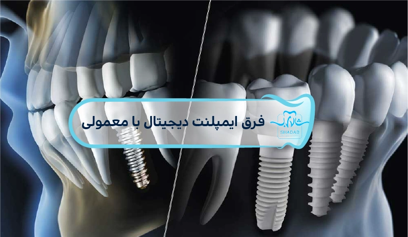 difference between digital regular implants