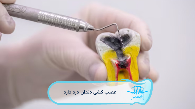does root canal hurt