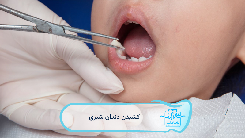 extraction-baby-teeth.webp