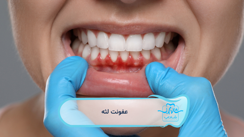 gum-infection.webp