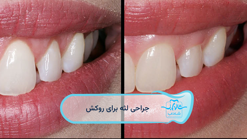 gum surgery for crowns