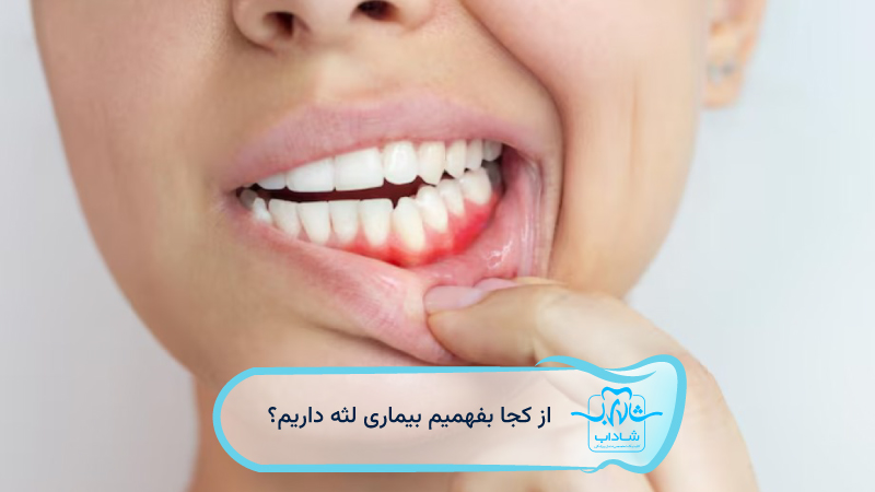 how do know if have gum disease