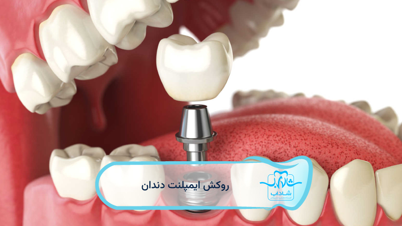 implant-veneer.webp