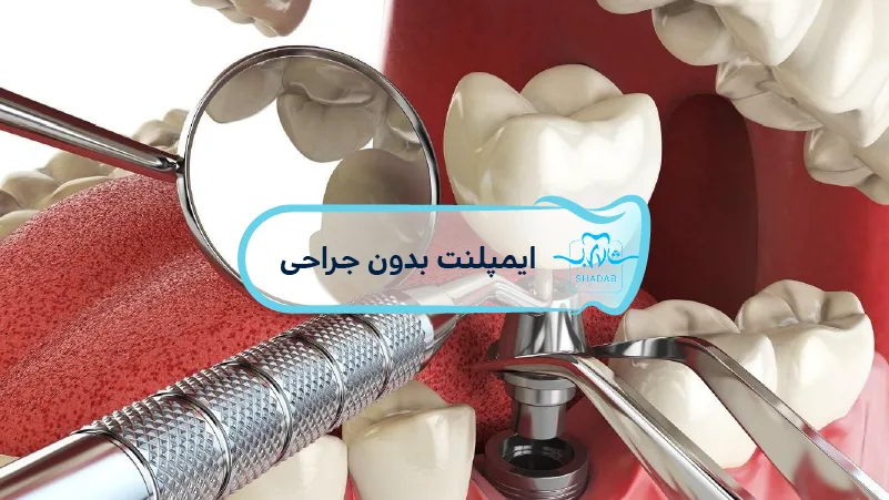 implants without surgery