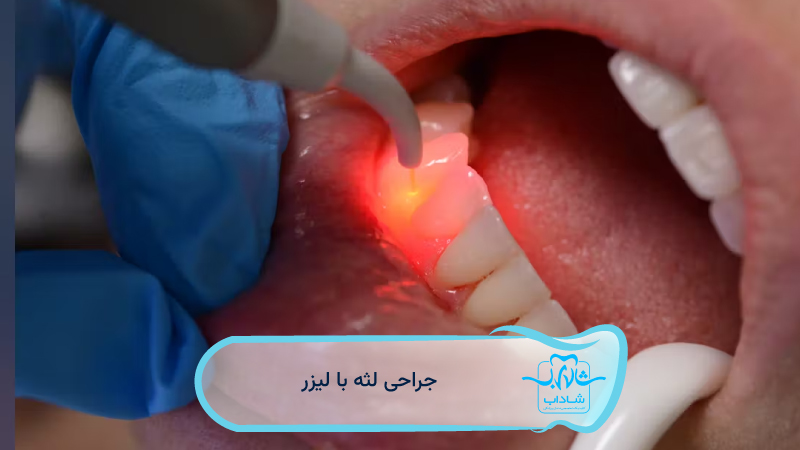 laser gum surgery