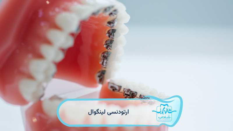 lingual orthodontics