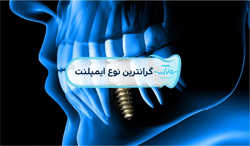 most expensive dental implant