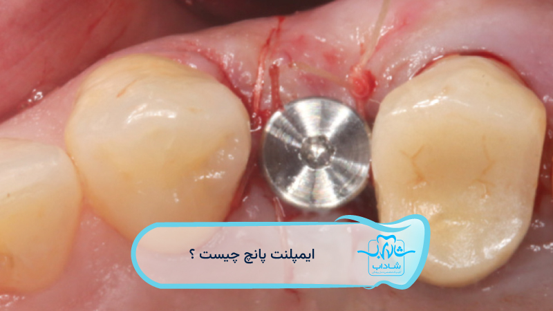 punch implant