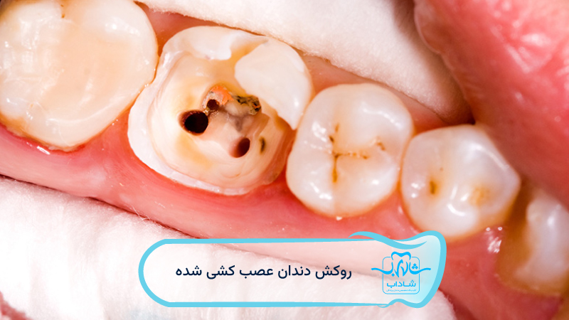 root-canal-dental-crown.webp
