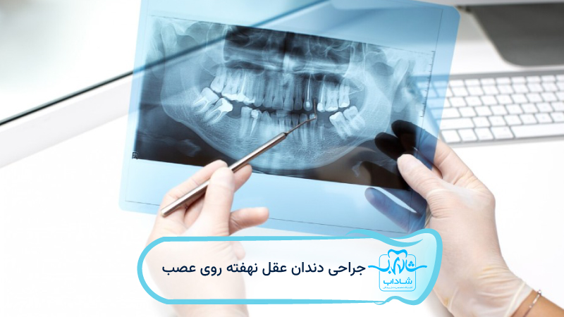 surgery Impacted wisdom tooth close nerve
