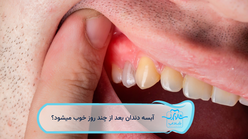 tooth-abscess-heals-after-few-days.webp