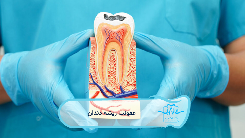 tooth root infection