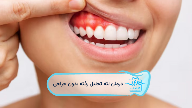 treating receding gums without surgery