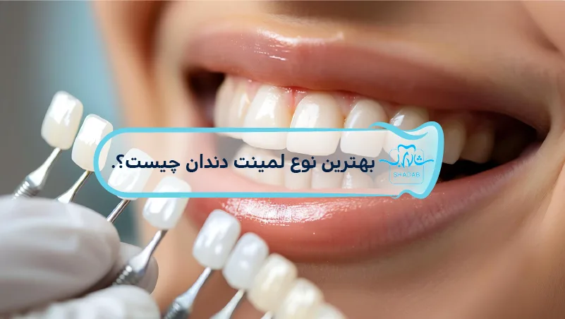 what is best type dental laminate