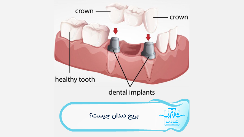 what is dental bridge