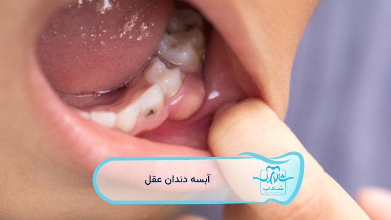 wisdom tooth abscess